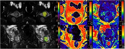 APTw combined with mDixon−Quant imaging to distinguish the differentiation degree of cervical squamous carcinoma